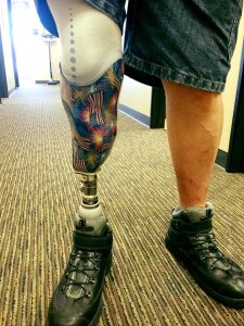 Prosthetics – Below Knee – Capstone Orthopedic